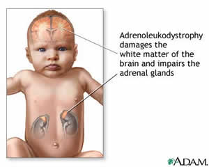 Photo showing where Adrenoleukodystrohpy does damage - brain and adrenal glands.